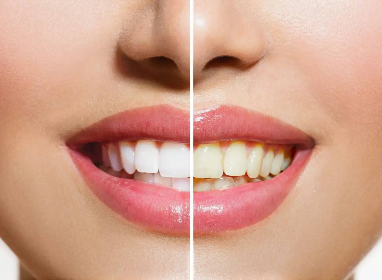 White Spots on Teeth: Do not take white spots on teeth lightly, this way you will get rid of them easily.