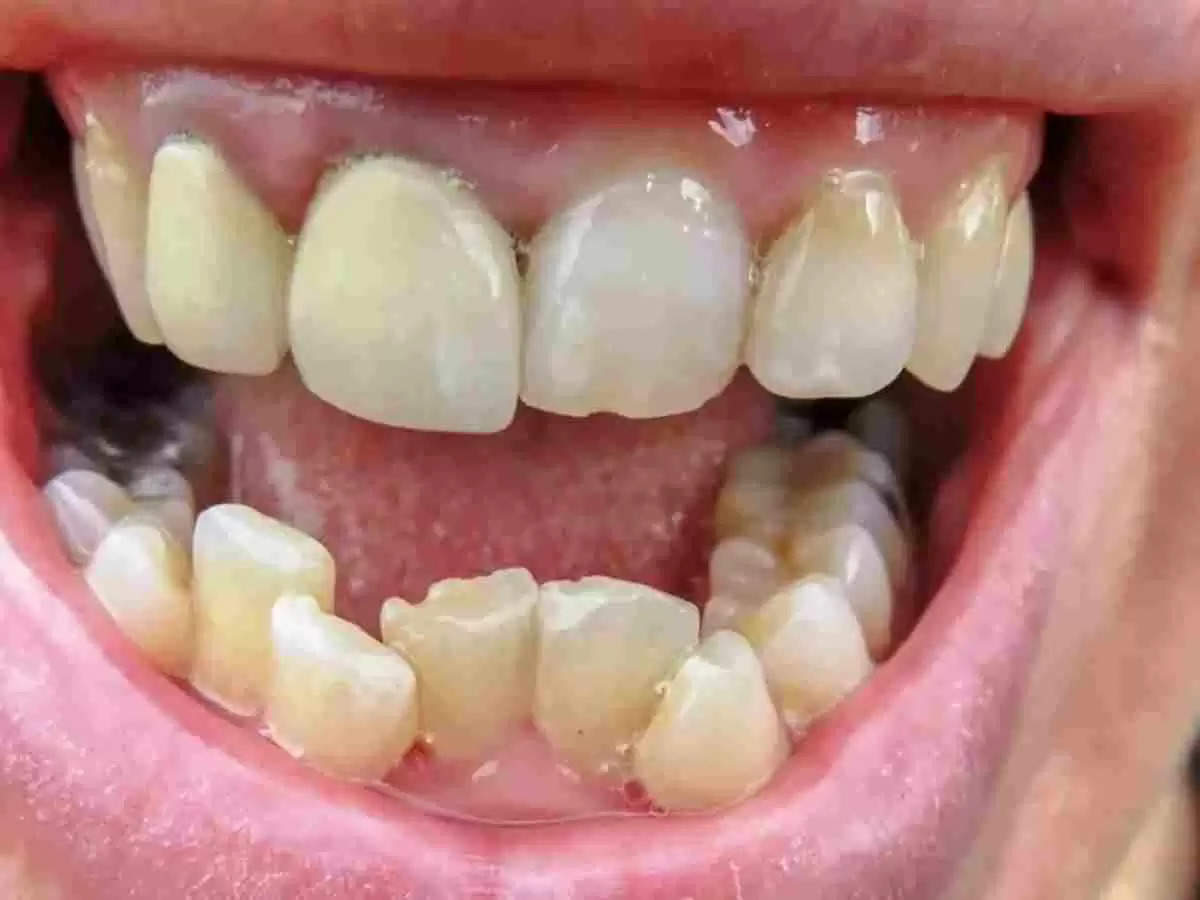 UP का यह उपकरण तीन महीने में सीधे करेगा टेढ़े-मेढ़े दांत