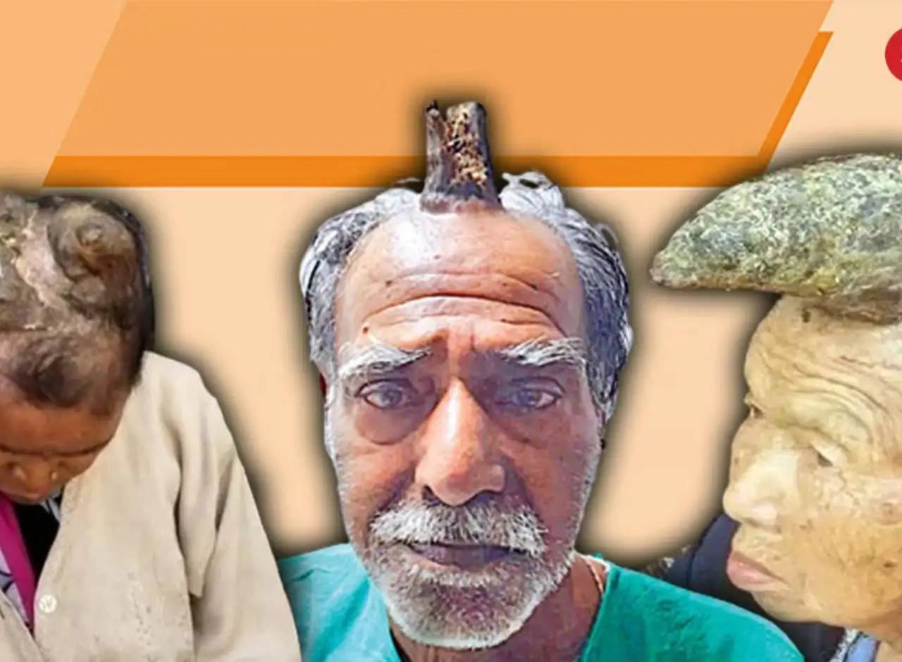 Ajab Gajab: Horns like animals are growing on the heads of humans, even doctors are surprised to see them